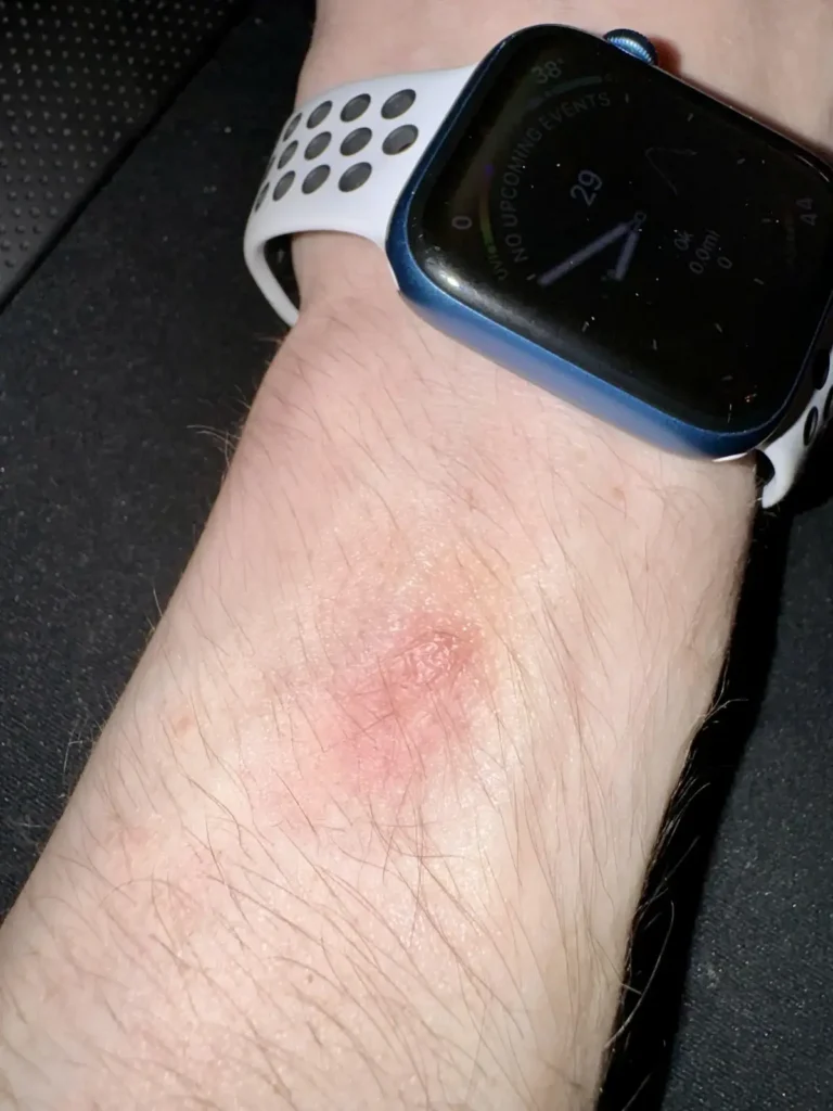Apple Watch cilt tahrişi img1